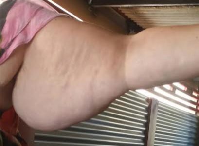 Lipoedema Arm